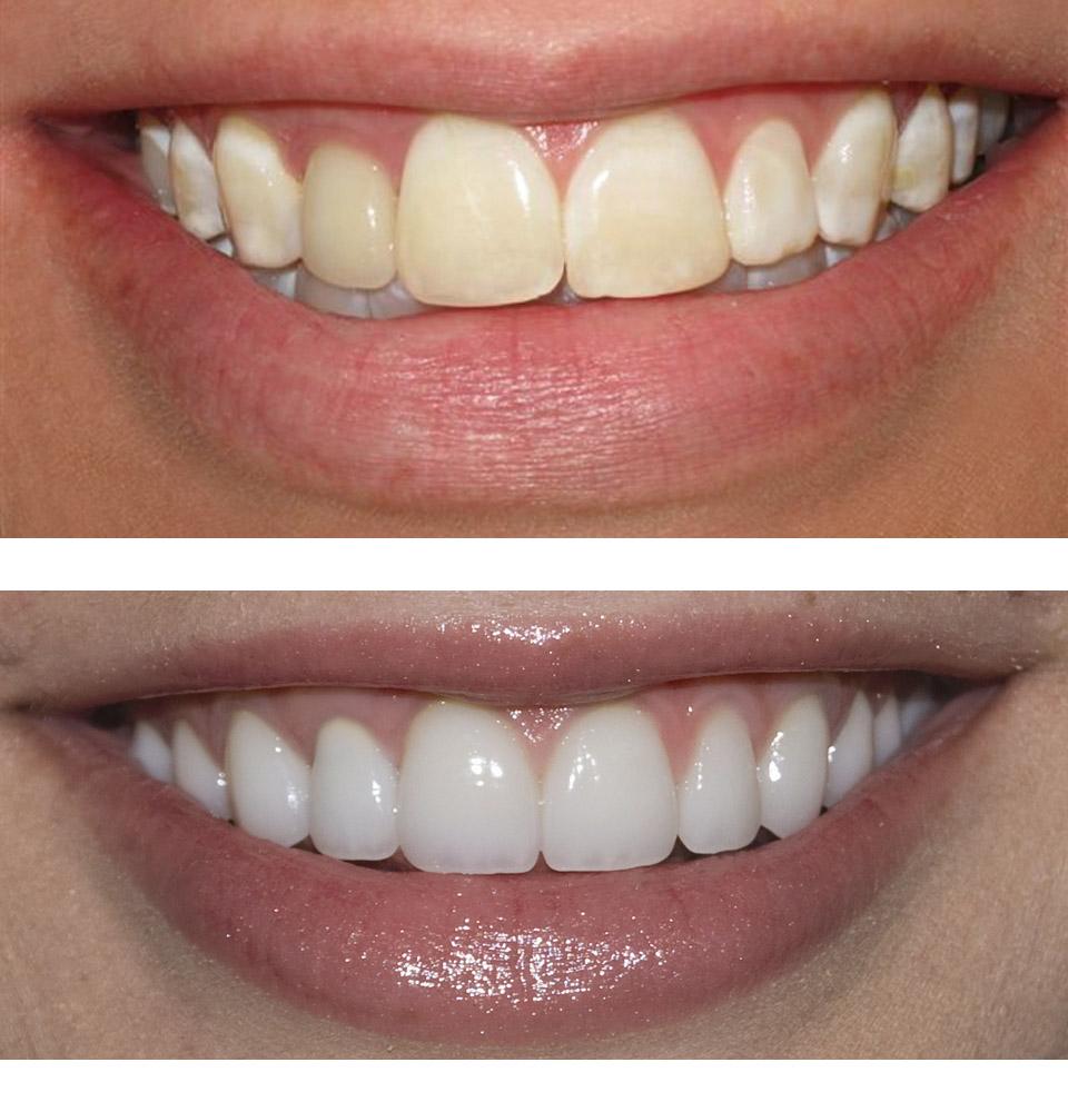 Porcelain Veneers Melbourne Porcelain Veneers Melbourne