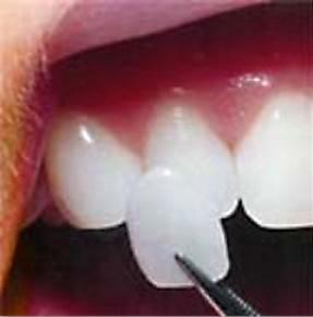 Porcelain Veneers Melbourne Porcelain Veneers Melbourne