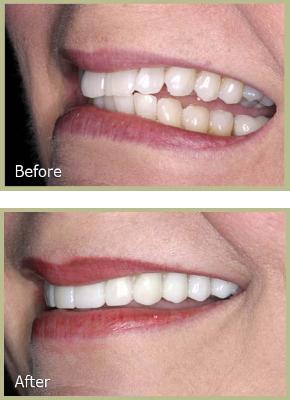 tmj treatments splint step wise therapies treatment jaw dental surgical treat