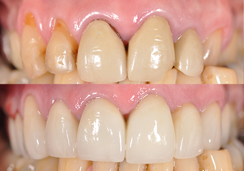 Porcelain Veneers Melbourne Porcelain Veneers Melbourne