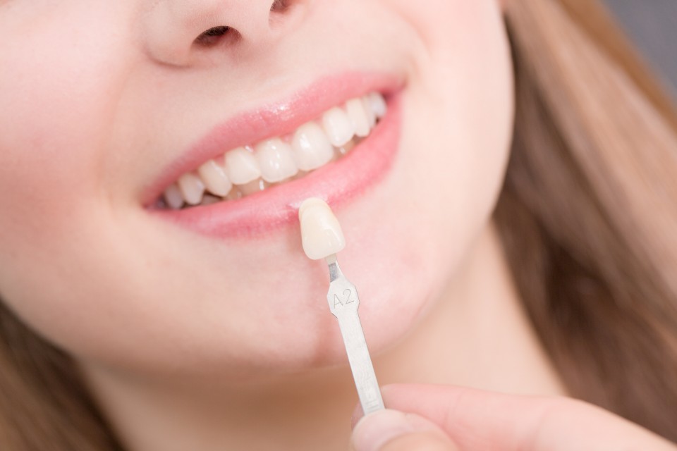 Porcelain Veneers melbourne Porcelain Veneers melbourne