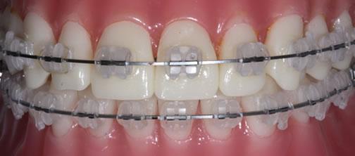 different types of braces for adultes handicapés