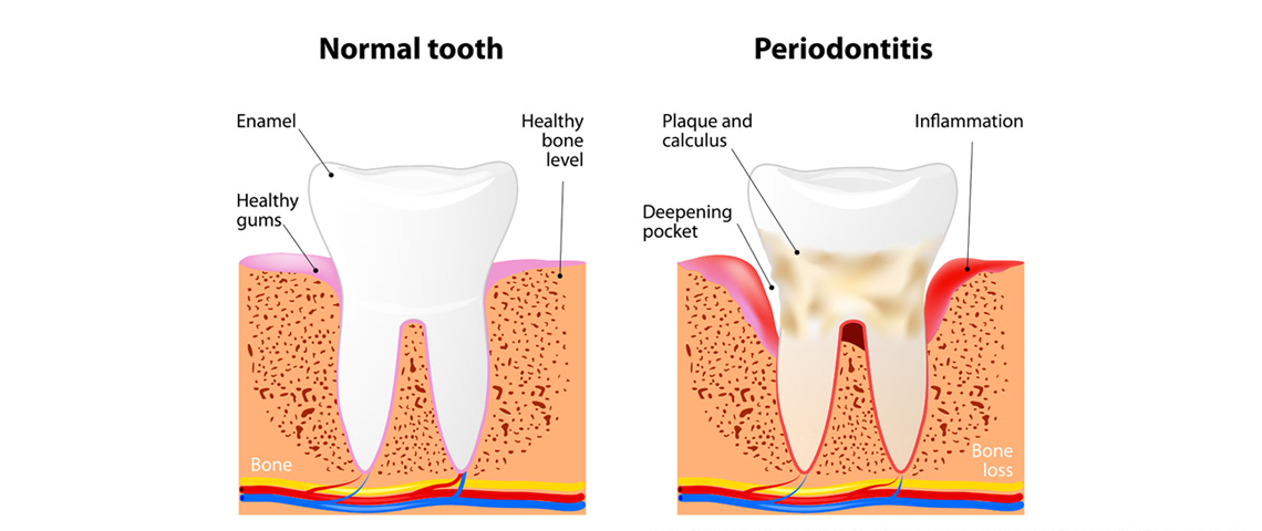 Periodontal Gum Disease